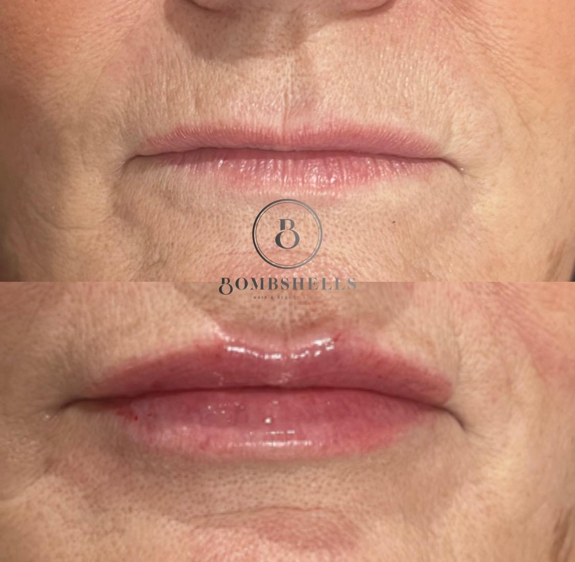 Natural Lip Enhancement Natural Lip Enhancement